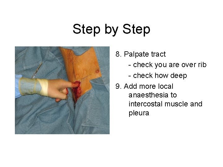 Step by Step 8. Palpate tract - check you are over rib - check