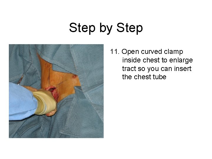 Step by Step 11. Open curved clamp inside chest to enlarge tract so you