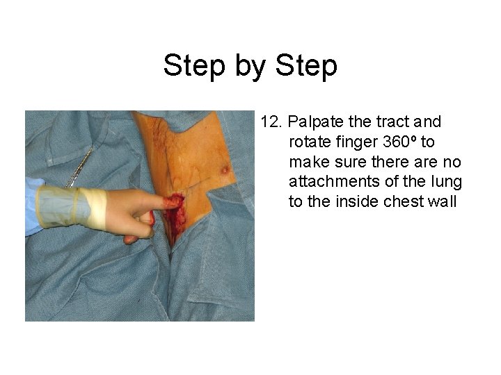 Step by Step 12. Palpate the tract and rotate finger 360º to make sure