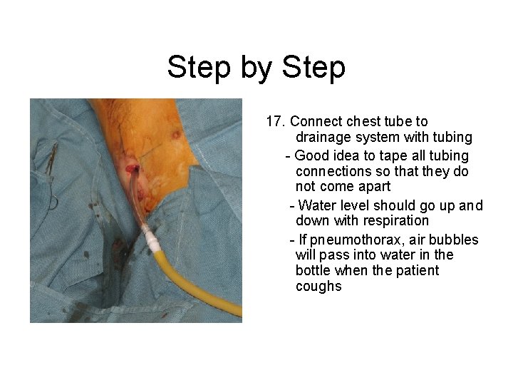 Step by Step 17. Connect chest tube to drainage system with tubing - Good