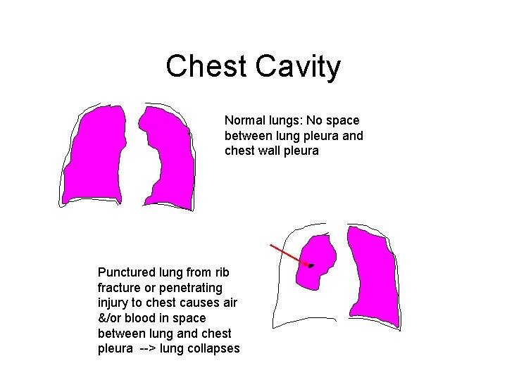 Chest Cavity Normal lungs: No space between lung pleura and chest wall pleura Punctured