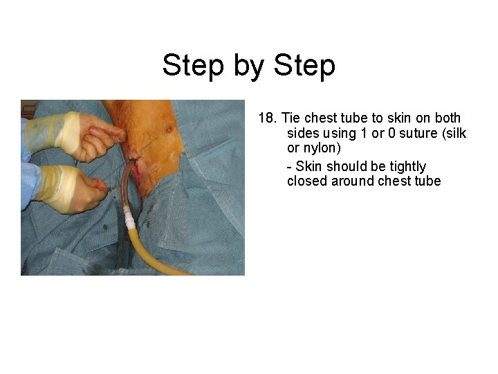 Step by Step 18. Tie chest tube to skin on both sides using 1