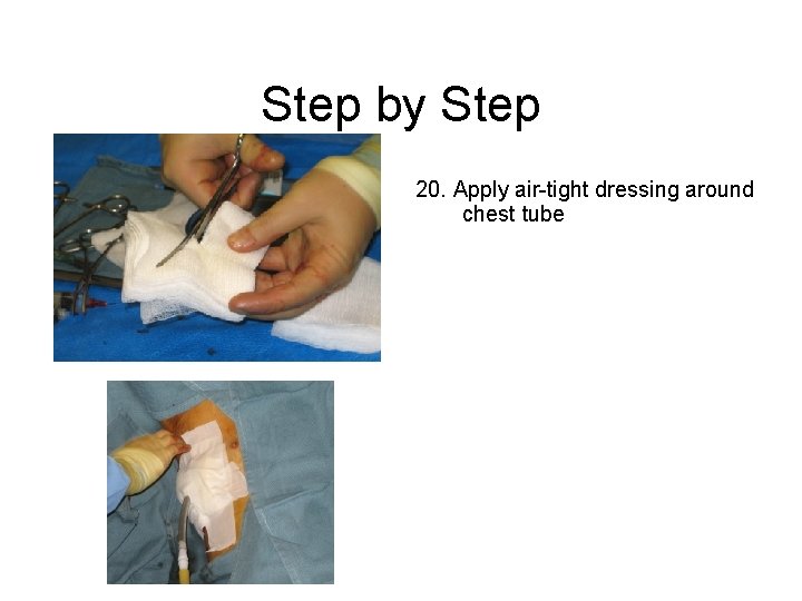 Step by Step 20. Apply air-tight dressing around chest tube 