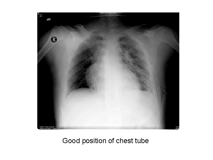 Good position of chest tube 
