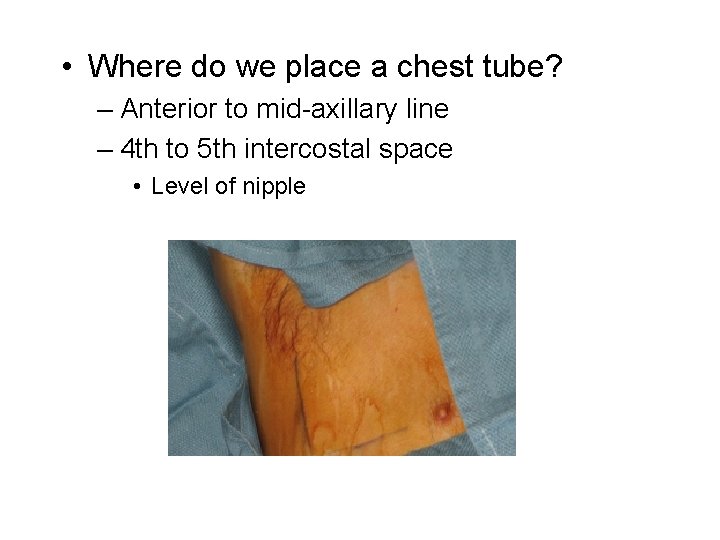  • Where do we place a chest tube? – Anterior to mid-axillary line