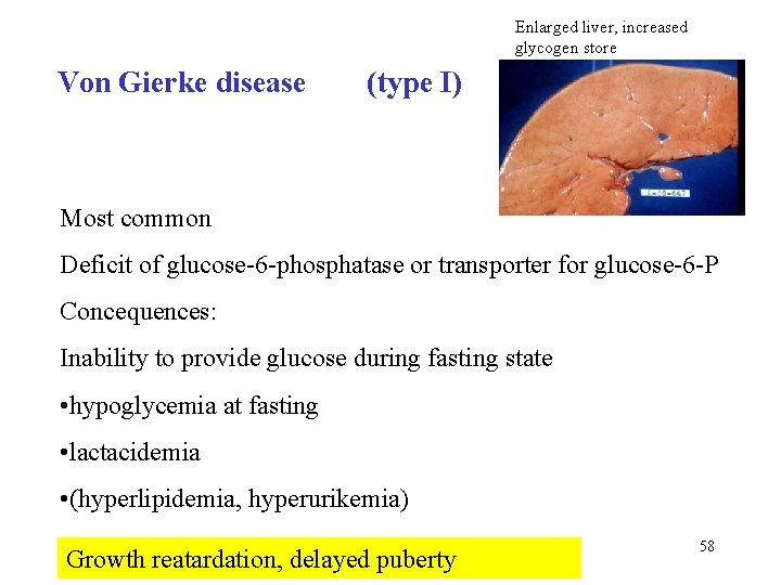Enlarged liver, increased glycogen store Von Gierke disease (type I) Most common Deficit of