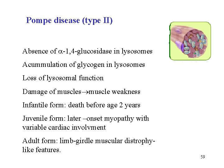 Pompe disease (type II) Absence of -1, 4 -glucosidase in lysosomes Acummulation of glycogen