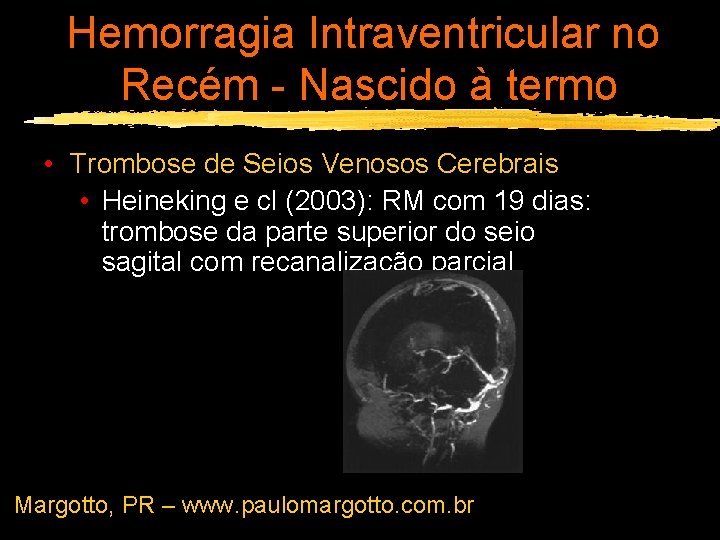 Hemorragia Intraventricular no Recém - Nascido à termo • Trombose de Seios Venosos Cerebrais