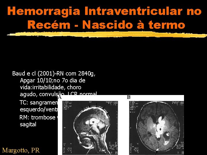 Hemorragia Intraventricular no Recém - Nascido à termo Baud e cl (2001)-RN com 2840