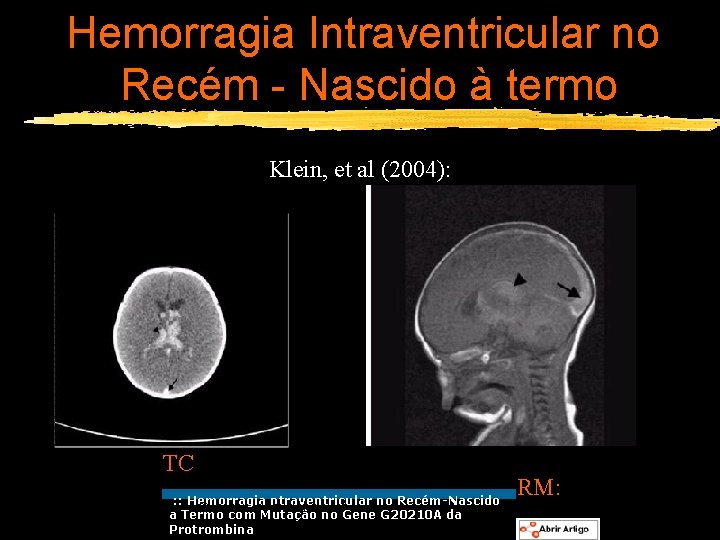 Hemorragia Intraventricular no Recém - Nascido à termo Klein, et al (2004): TC :