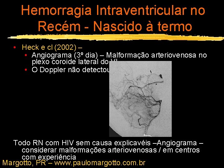 Hemorragia Intraventricular no Recém - Nascido à termo • Heck e cl (2002) –