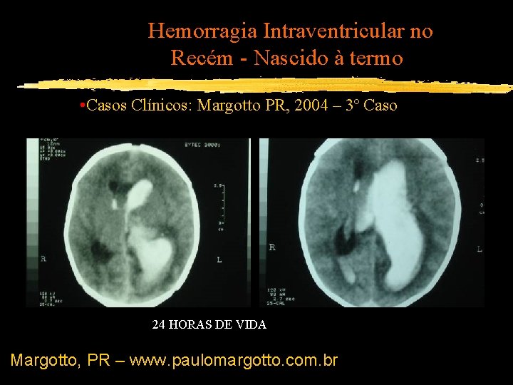 Hemorragia Intraventricular no Recém - Nascido à termo • Casos Clínicos: Margotto PR, 2004