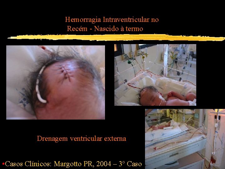 Hemorragia Intraventricular no Recém - Nascido à termo Drenagem ventricular externa • Casos Clínicos: