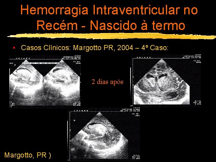 Hemorragia Intraventricular no Recém - Nascido à termo • Casos Clínicos: Margotto PR, 2004
