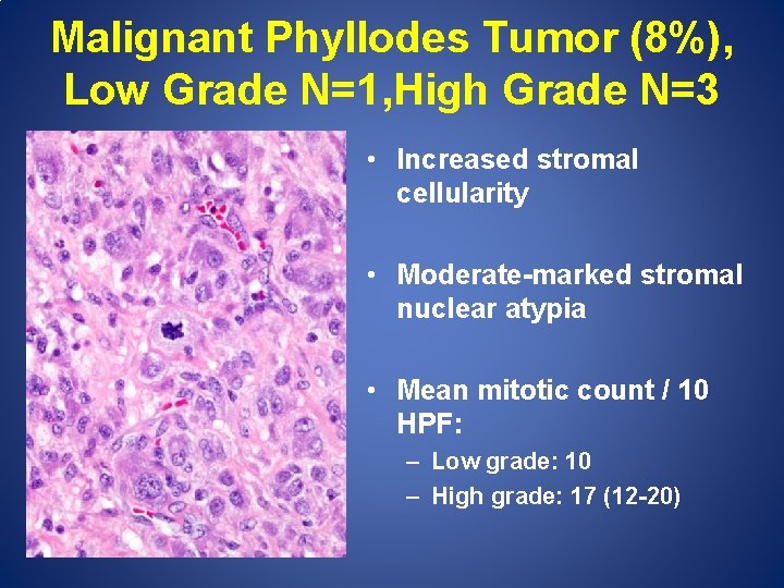 Malignant Phyllodes Tumor (8%), Low Grade N=1, High Grade N=3 • Increased stromal cellularity