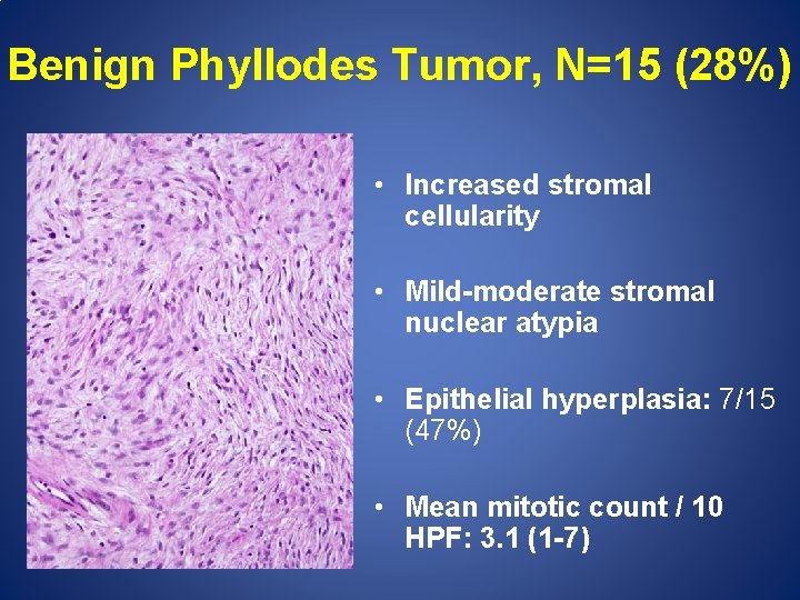 Benign Phyllodes Tumor, N=15 (28%) • Increased stromal cellularity • Mild-moderate stromal nuclear atypia