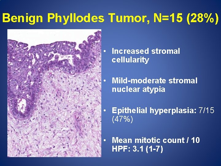 Benign Phyllodes Tumor, N=15 (28%) • Increased stromal cellularity • Mild-moderate stromal nuclear atypia