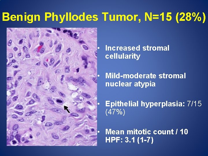 Benign Phyllodes Tumor, N=15 (28%) • Increased stromal cellularity • Mild-moderate stromal nuclear atypia