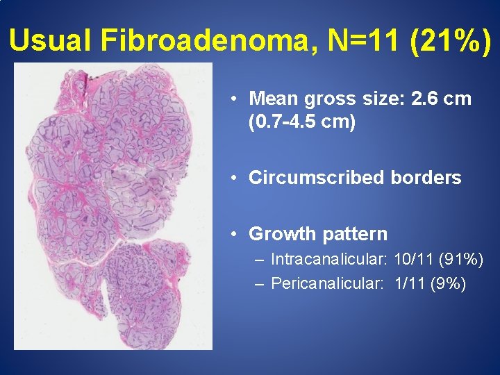 Usual Fibroadenoma, N=11 (21%) • Mean gross size: 2. 6 cm (0. 7 -4.