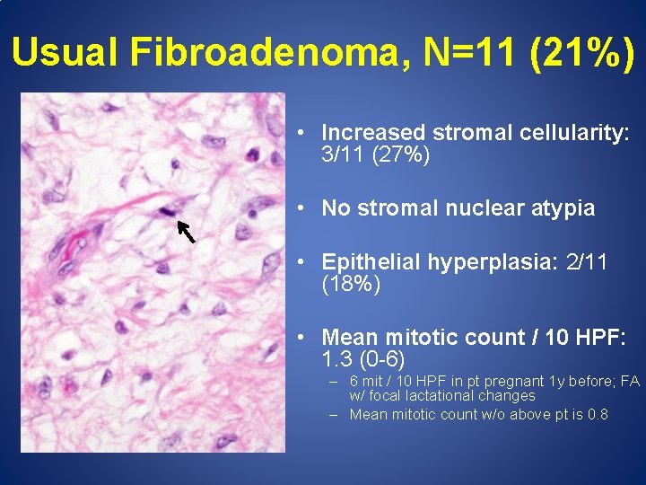 Usual Fibroadenoma, N=11 (21%) • Increased stromal cellularity: 3/11 (27%) • No stromal nuclear
