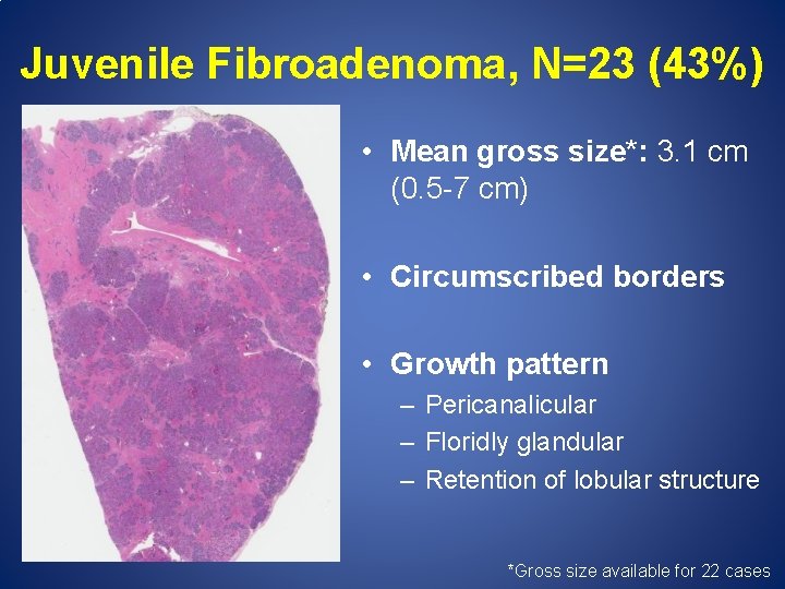 Juvenile Fibroadenoma, N=23 (43%) • Mean gross size*: 3. 1 cm (0. 5 -7