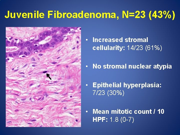 Juvenile Fibroadenoma, N=23 (43%) • Increased stromal cellularity: 14/23 (61%) • No stromal nuclear
