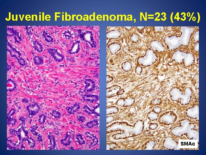 Juvenile Fibroadenoma, N=23 (43%) SMAα 