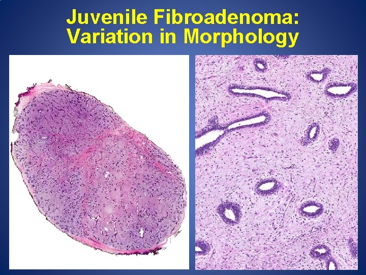 Juvenile Fibroadenoma: Variation in Morphology 