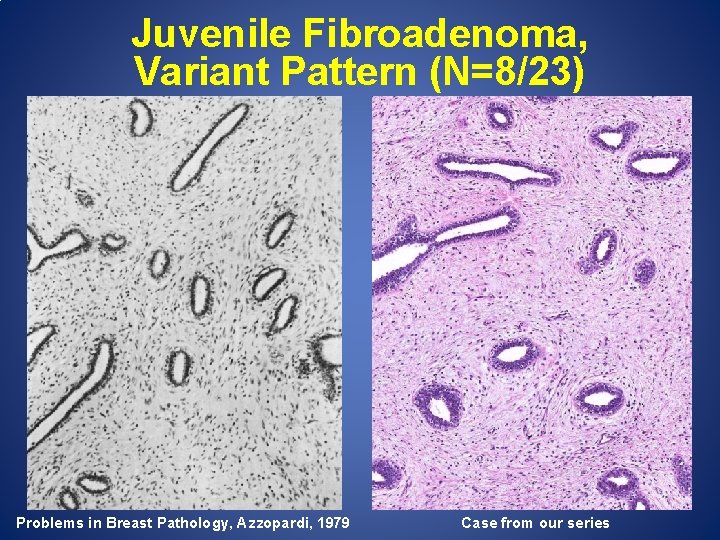 Juvenile Fibroadenoma, Variant Pattern (N=8/23) Problems in Breast Pathology, Azzopardi, 1979 Case from our