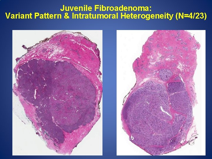 Juvenile Fibroadenoma: Variant Pattern & Intratumoral Heterogeneity (N=4/23) 