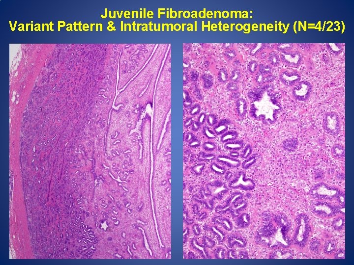 Juvenile Fibroadenoma: Variant Pattern & Intratumoral Heterogeneity (N=4/23) 