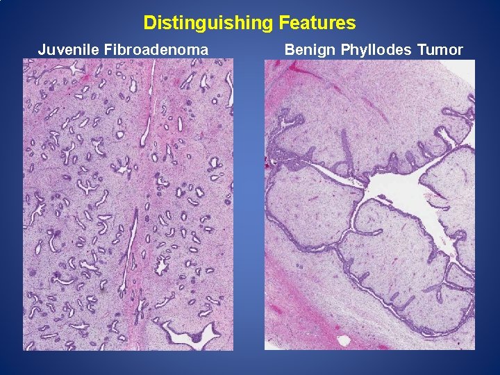 Distinguishing Features Juvenile Fibroadenoma Benign Phyllodes Tumor 