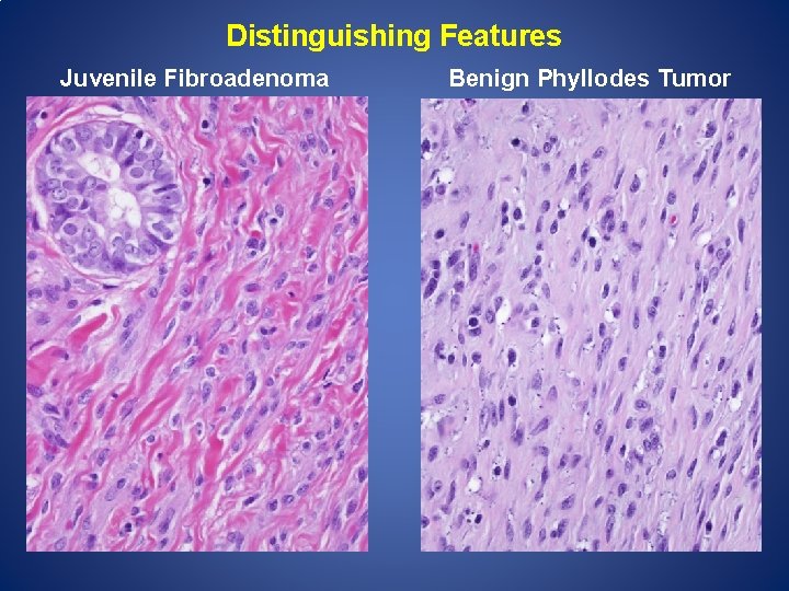 Distinguishing Features Juvenile Fibroadenoma Benign Phyllodes Tumor 