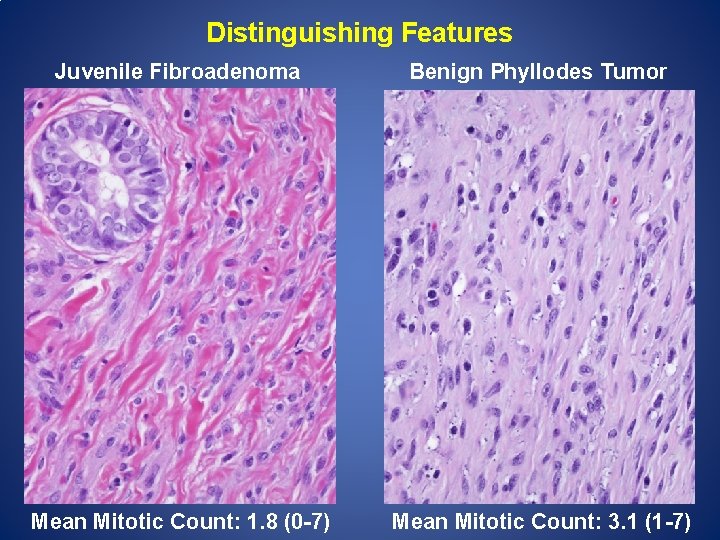 Distinguishing Features Juvenile Fibroadenoma Benign Phyllodes Tumor Mean Mitotic Count: 1. 8 (0 -7)