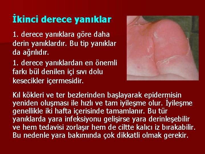 İkinci derece yanıklar 1. derece yanıklara göre daha derin yanıklardır. Bu tip yanıklar da