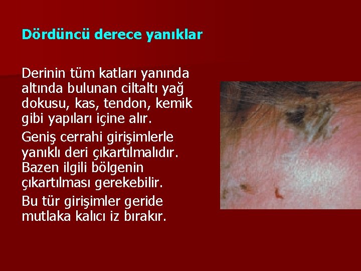 Dördüncü derece yanıklar Derinin tüm katları yanında altında bulunan ciltaltı yağ dokusu, kas, tendon,