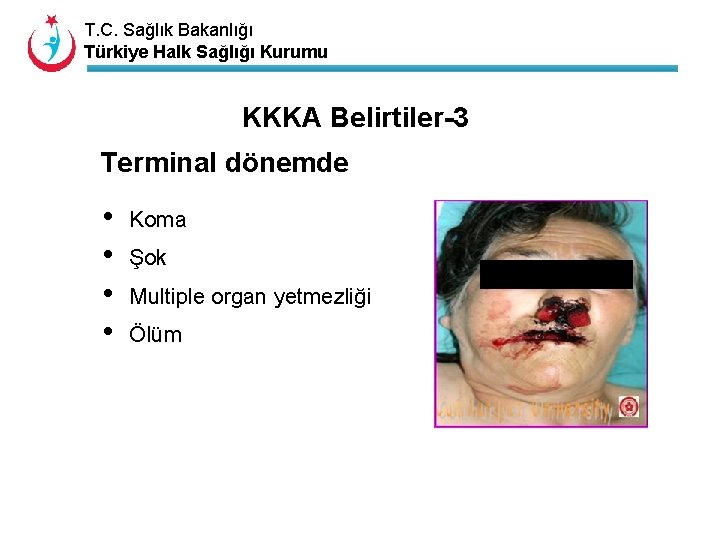 T. C. Sağlık Bakanlığı Türkiye Halk Sağlığı Kurumu KKKA Belirtiler-3 Terminal dönemde • •