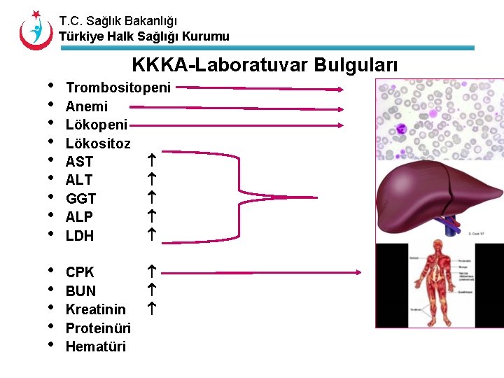 T. C. Sağlık Bakanlığı Türkiye Halk Sağlığı Kurumu KKKA-Laboratuvar Bulguları • • • Trombositopeni