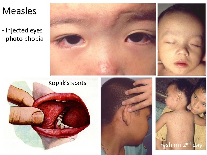 Measles - injected eyes - photo phobia Koplik’s spots rash on 2 nd day