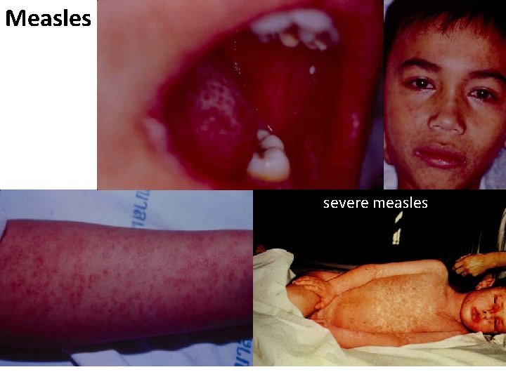 Measles severe measles 