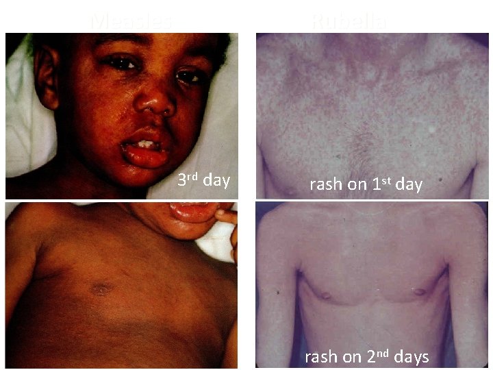 Measles Rubella 3 rd day rash on 1 st day rash on 2 nd