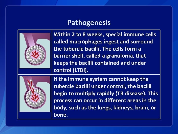 Pathogenesis Within 2 to 8 weeks, special immune cells called macrophages ingest and surround