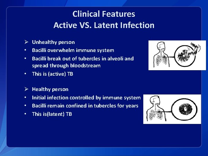 Clinical Features Active VS. Latent Infection Ø Unhealthy person • Bacilli overwhelm immune system