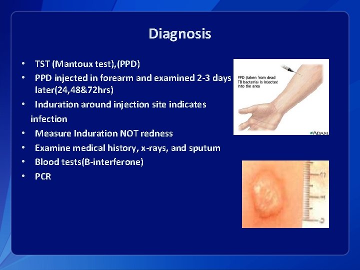 Diagnosis • TST (Mantoux test), (PPD) • PPD injected in forearm and examined 2