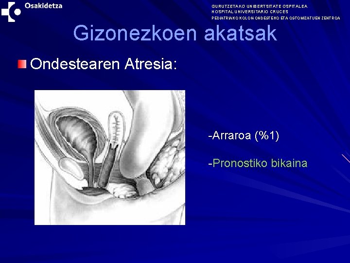 GURUTZETAKO UNIBERTSITATE OSPITALEA HOSPITAL UNIVERSITARIO CRUCES PEDIATRIAKO KOLON-ONDESTEKO ETA OSTOMIZATUEN ZENTROA Gizonezkoen akatsak Ondestearen