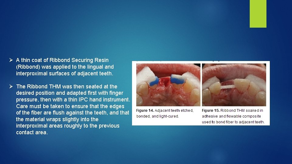 Ø A thin coat of Ribbond Securing Resin (Ribbond) was applied to the lingual