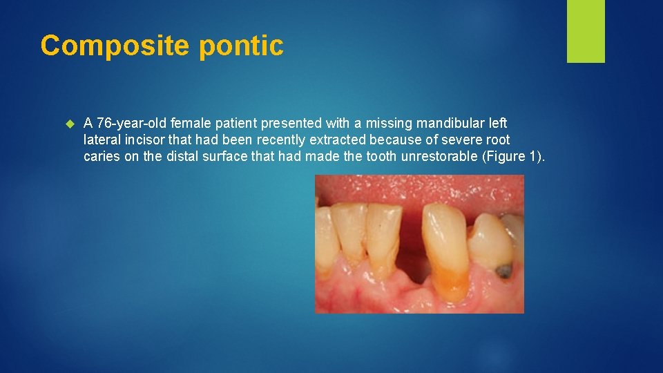 Composite pontic A 76 year old female patient presented with a missing mandibular left
