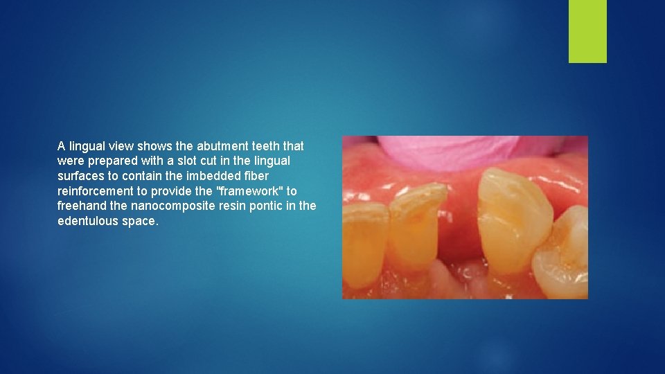 A lingual view shows the abutment teeth that were prepared with a slot cut