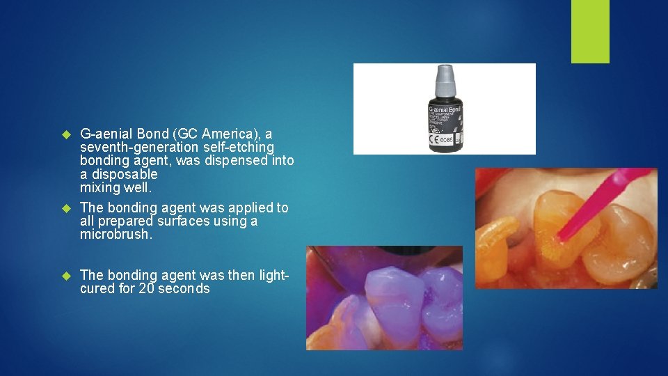 G aenial Bond (GC America), a seventh generation self etching bonding agent, was dispensed
