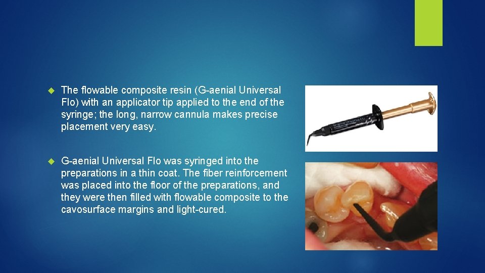  The flowable composite resin (G aenial Universal Flo) with an applicator tip applied